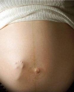 임신 중에 복부에 박리 : 출산 후 사라지는 이유