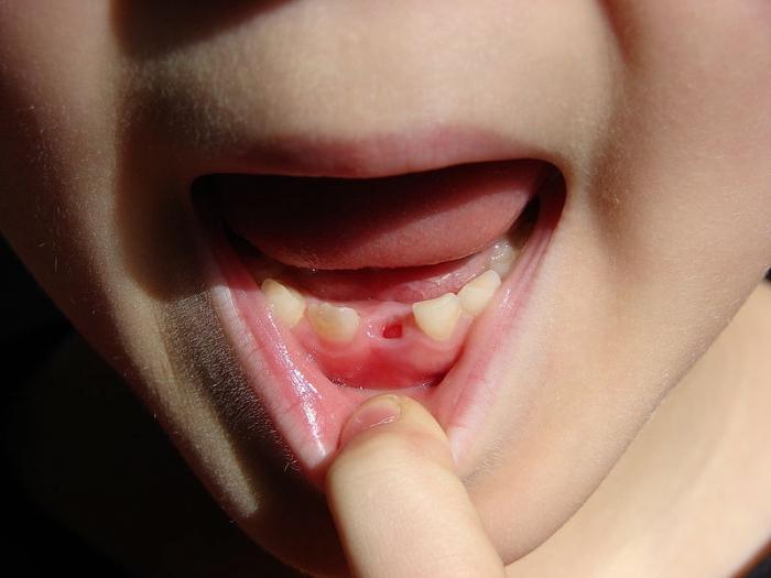 부모님이 생각 하듯이 아이의 치아가 끔찍한 변화입니까?