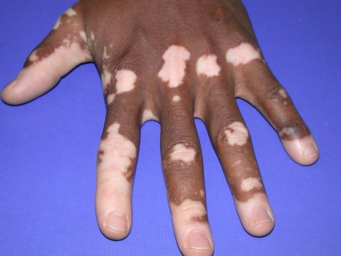 vitiligo의 증상과 원인은 무엇입니까?
